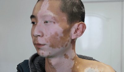 白癜风康复病例