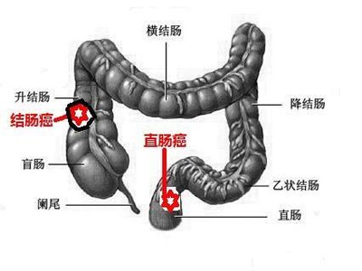 中医治疗直肠癌