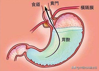 李先生胃食管反流逐渐消失